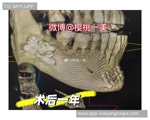 米兰官方宣布奇克下颌骨骨折手术成功预计缺阵八周